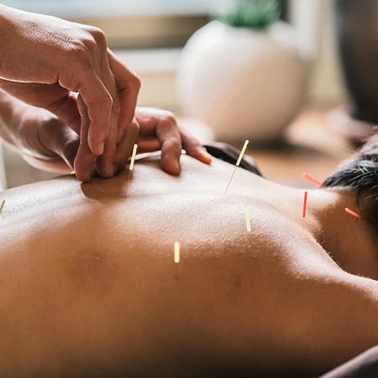 Man receiving acupuncture treatment