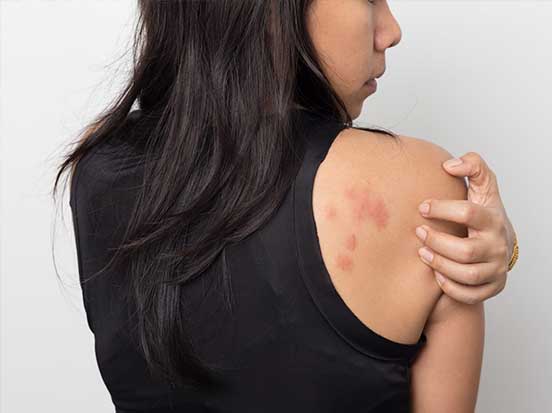 Woman with a rash on her back